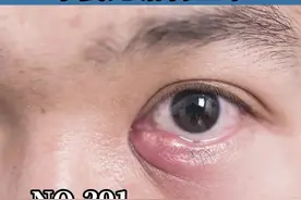 眼周长了红肿疙瘩，不要再傻傻的跑错了科室#睑腺炎 #眼科#眼皮肿 #皮肤 #医学科普 视频封面