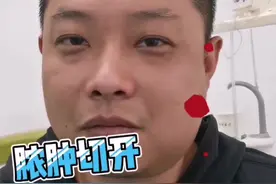 智齿发炎，必要时切开排脓才好得快#拔智齿 #口腔科普 视频封面