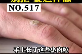 手上长了硬硬的小疙瘩，皮肤科医生教你处理#寻常疣 #科普 #皮肤 视频封面