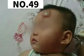 孩子磕碰很常见，但如果摔到头部，家长应严密观察孩子状态，发现异常尽早就医#医学科普 #关爱儿童健康 视频封面