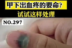 #指甲磕碰出现淤血疼的要命？一定要这样处理。#医学科普 #科普 