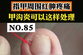 指甲周围红肿疼痛，走起路来很痛苦，这是#甲沟 炎，我们可以分情况这样处理#健康 #科普 #皮肤 #指甲 视频封面