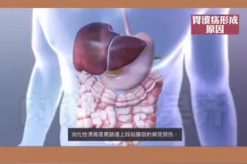 #胃肠内镜医生吴齐 3D动画演示：#胃溃疡 #消化性溃疡 形成原因和一般症状#胃肠健康视频封面