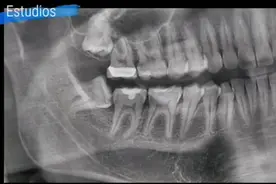神奇，原来牙医是这样拔智齿的，看完智齿竟然也不疼了！#牙齿视频封面