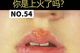 嘴角总长泡，你是#上火了吗？#皮肤 #科普 视频封面