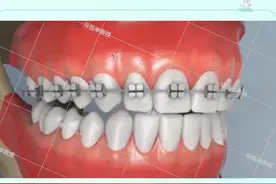 牙齿矫正中为什么要打骨钉？一起看看吧#口腔健康 #dou来护牙
