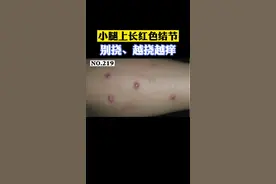 小腿出现红色发痒结节，不要挠，可以这样处理。#结节性痒疹 #医学科普 #皮肤 视频封面