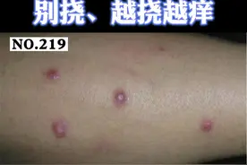 小腿出现红色发痒结节，不要挠，可以这样处理。#结节性痒疹 #医学科普 #皮肤 视频封面