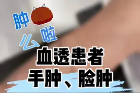 #血透患者 手肿，脸肿，特别是以前插管血透患者。#医学科普 #抖医医生 #我的白大褂 #血透 #血透室护士 #尿毒症