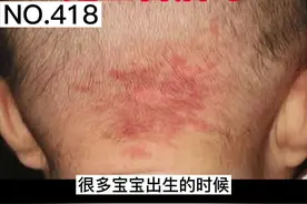 宝宝额头中央、颈后面、眼睑处有一些红色的“胎记”，家长千万别乱处理！#胎记 #鲜红斑痣 #医学科普 视频封面