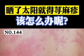 日光性荨麻疹，晒了太阳，皮肤起风团，瘙痒刺痛怎么办#医学科普 #皮肤 #荨麻疹 视频封面