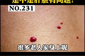 身上长了红色的小肉球，看起来像#红痣 一样，这个是代表肝脏有问题吗？ #朱砂痣 #皮肤 #医学科普 视频封面
