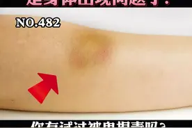 身上总是青一块紫一块？医生告诉你“鬼捏青”的原因。#健康 #涨知识 #科普 视频封面