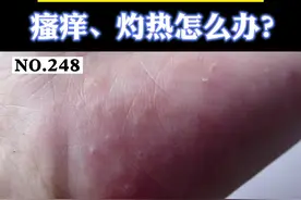 #医学科普女性朋友洗碗过后，有时手上出现密集小水疱，瘙痒有灼热感，#汗疱疹 可以这样处理。#水泡 视频封面