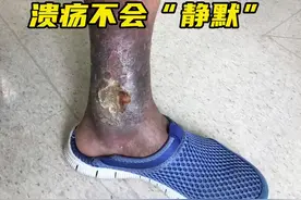 #医学科普 #上海话 #静脉曲张 #疫情下的生活 #手术视频封面