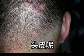头上长了头藓，很痒。五部教你处理！#皮肤 #头藓视频封面