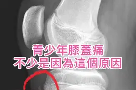 #胫骨结节骨骺炎，大都保守治疗，骨骺闭合后，基本自愈。@张弛医生视频封面