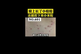 背上的小痘痘，还能抠出一粒米，孙叔教你处理#马拉色菌毛囊炎 #医学科普 