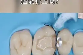 牙齿蛀了个大洞，还能补上吗？#蛀牙 #补牙 @洁牙小姐姐的故事 视频封面