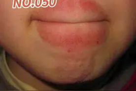 很多小孩总是爱舔嘴唇，舔着舔着嘴周就形成了一个圈圈，影响美观不说，还有可能能给孩子造成自卑心理，家长朋友们要引起注意，及时纠正#口腔健康 #嘴唇 #舌舔皮炎视频封面