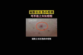 臀部长小疙瘩，很多人以为是上火长痘痘了，其实是#毛囊炎 ，大部分是和这个习惯有关#皮肤 #健康科普 