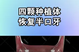 半口缺牙是怎么用4颗种植体恢复的？一起看看吧#健康真相官 #口腔科普 视频封面