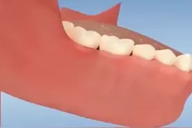 为什么根管治疗那么疼？ #根管治疗 #蛀牙 #牙疼 #南京 视频封面