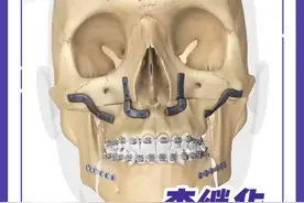 科普时间👉正颌手术风险大吗？#正颌 #医学科普#安全变美 #华西口腔视频封面