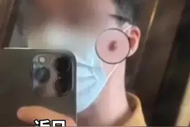 痘痘真的不要乱挤！男子反复挤痘后出血不止，被诊断为血管瘤。视频封面