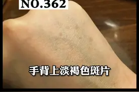 手背上有一些褐色的斑块，是什么呢？会传染吗？#科普 #皮肤 视频封面