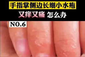 手掌手指侧边长的密集小水疱，又痛又痒，#汗疱疹 试试这样处理#医疗科普 #医学小知识 视频封面