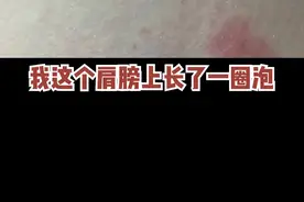 肩膀上长了一圈泡不知道是什么？#带状疱疹 会不会传染呢？#护肤管理 #健康科普视频封面