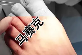 出现#嵌甲 甲沟y，别再傻傻去医院拔甲治疗了，这样做也能解决疼痛！#指甲视频封面