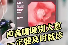 #声音嘶哑别大意，一定要及时就诊，这个老爷子声音嘶哑一年才来医院就诊，检查发现喉部#肿瘤。#医学科普 #倪晓光 视频封面