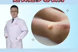 手上长了一个肉疙瘩，可以试试这样处理#寻常疣 #瘊子 #科普 #皮肤 视频封面