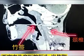 #危险瞬间男孩吃烤肠时不慎摔倒，15里面竹签插入喉咙视频封面