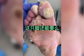 视频美女一只脚长二十多个鸡眼 看完极度舒适#修脚#解压视频封面
