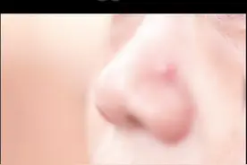 #痘痘 千万不要挤，钟医生给大家总结了三种药膏，更能针对性治疗！#皮肤视频封面