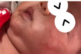 家长做好这四点，宝宝湿疹好的快#医学科普 #湿疹视频封面