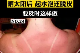 晒太阳后，皮肤起水泡 脱皮还伴有刺痛感，要及时这样做#日光性皮炎 #海边 #科普 