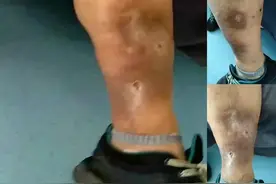 糖尿病综合症，服用肽后的效果！溃烂的漏已经愈合了！视频封面