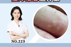 手上长这种小水泡，痒的怀疑人生，试试这个方法帮你解决#科普#汗疱疹#洗发水#家庭主妇 视频封面