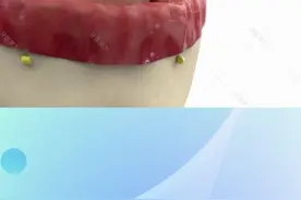 老年人半口缺牙或者全口缺牙怎么办，那就试试种植牙吧！#口腔科普 #dou是知识点 #郑州 视频封面