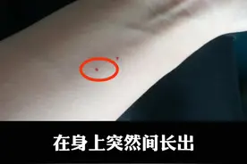 身上长红点痣，是肝不好？听听医生怎么说#肝 #科普 #皮肤 视频封面