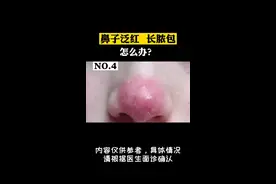 鼻子肿的红红的，还长小脓包这可能是#酒渣鼻 #玫瑰痤疮 怎么解决看这里#科普