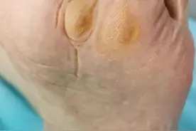 看视频学看皮肤病：鸡眼要与跖疣鉴别#皮肤病 视频封面