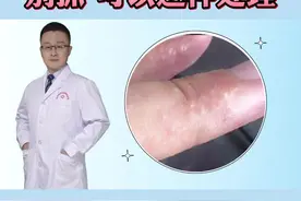 手上长密密麻麻的小水疱，非常痒，其实这是#汗疱疹 ，教你简单处理#健康科普 #皮肤 #皮肤瘙痒  视频封面
