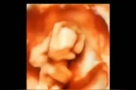 到了12周孕就该做nt超声了，此时胎宝宝都在干些啥？#孕期 #胎儿 #孕期知识 #超声影像 #四维彩超 #医学科普 视频封面