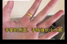 手上长一粒粒的小水疱，希望这个方法简单帮到您。#手癣 #水泡型脚气 #科普 视频封面
