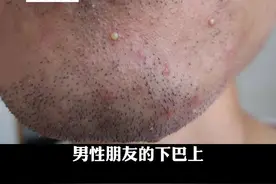 男性朋友胡须周围长丘疹、脓疱，非常胀痛，这样处理很简单#医学科普  #男友 视频封面